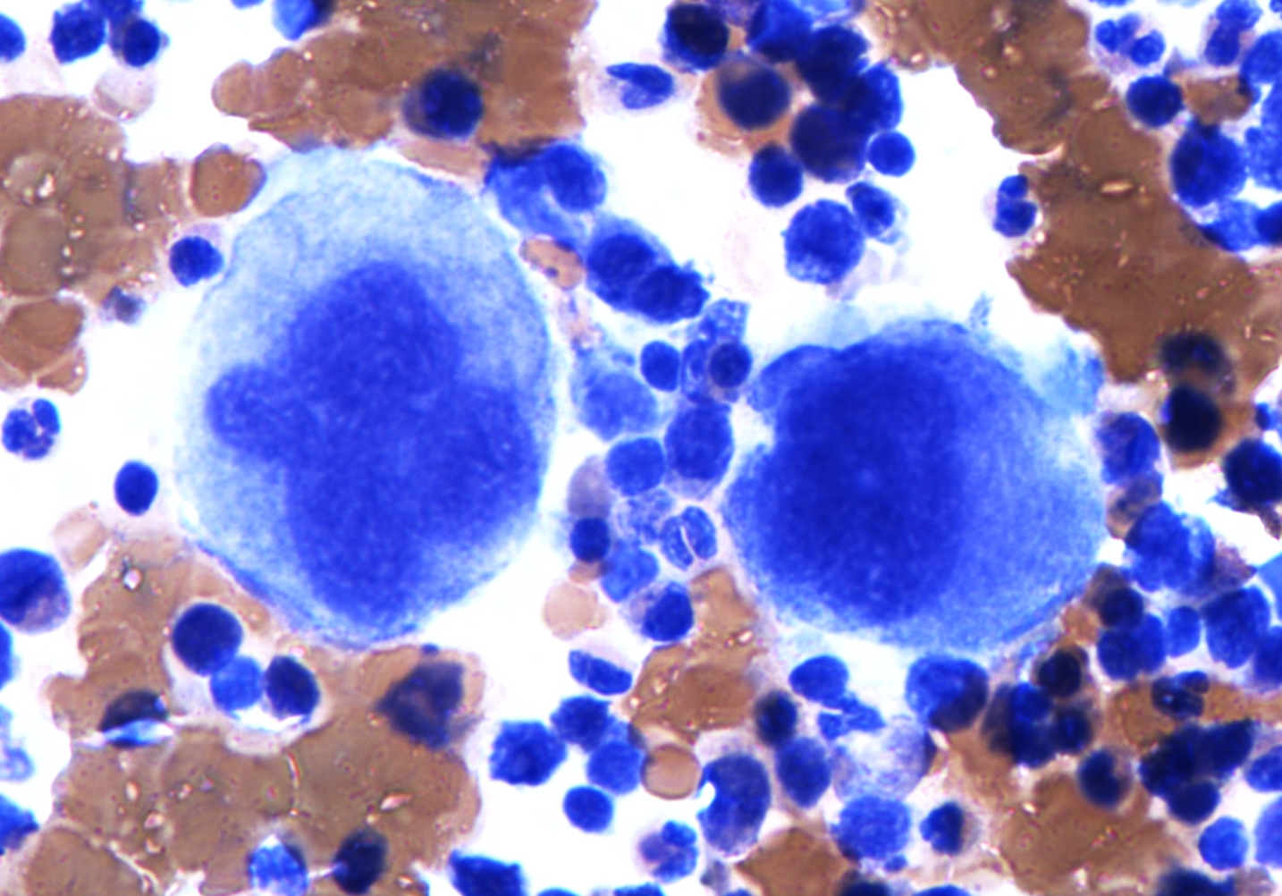 A stained marrow aspirate shows two very large megakaryocytes among much smaller marrow cells.