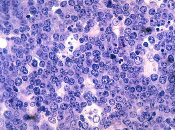 Densely packed malignant lymphocytes contain scattered pale macrophages that create a starry-sky appearance.