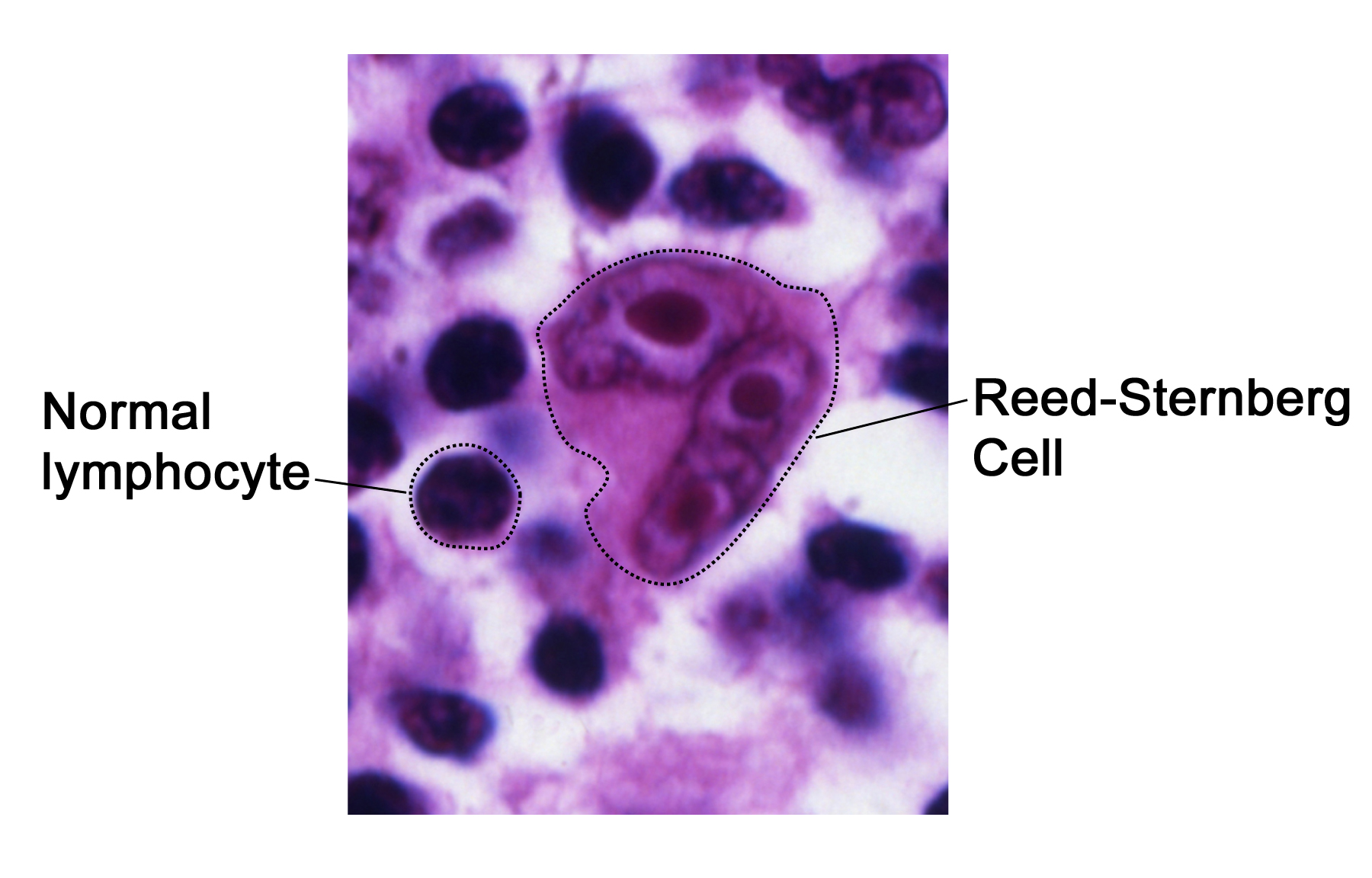 A large Reed-Sternberg cell with prominent nucleoli is surrounded by much smaller reactive lymphocytes.