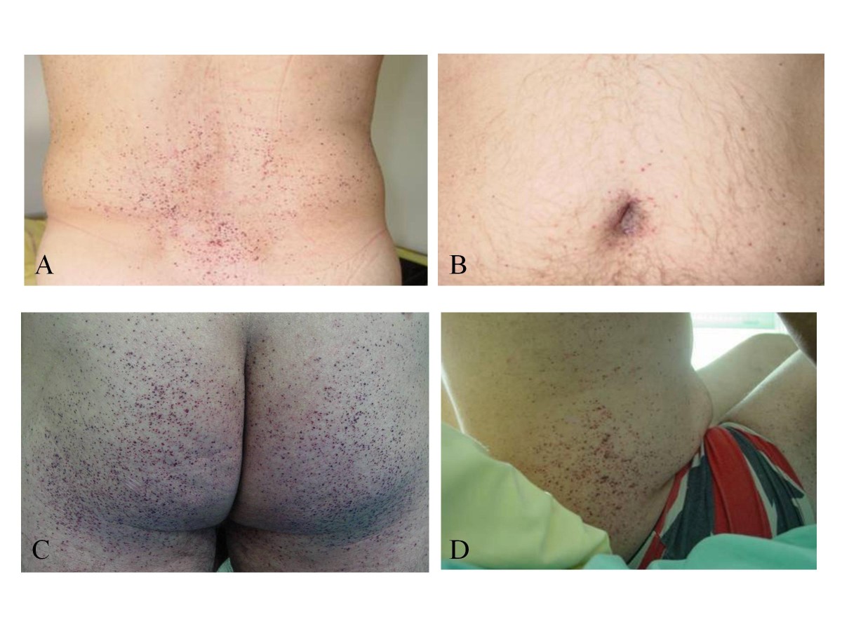 Four clinical photographs show clusters of small dark-red angiokeratomas on the lower back, umbilical region, buttocks, groin, and flank.