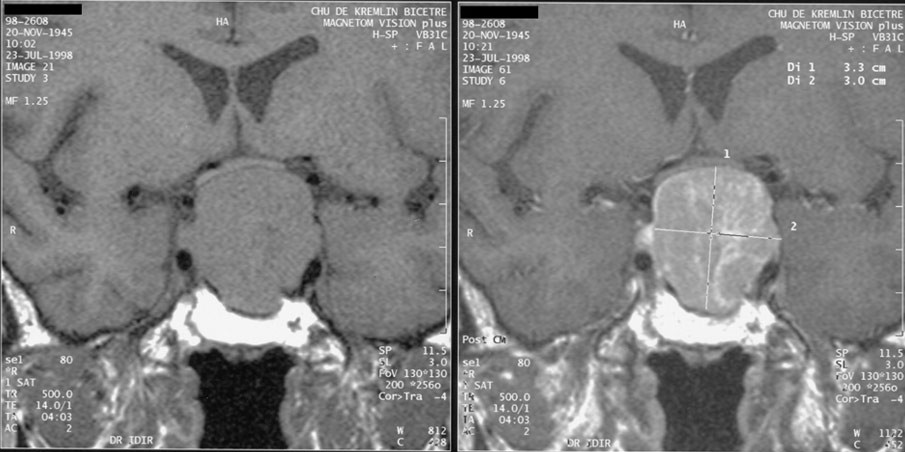 Two MRI views show a pituitary macroadenoma extending above the sella toward and compressing the optic chiasm.