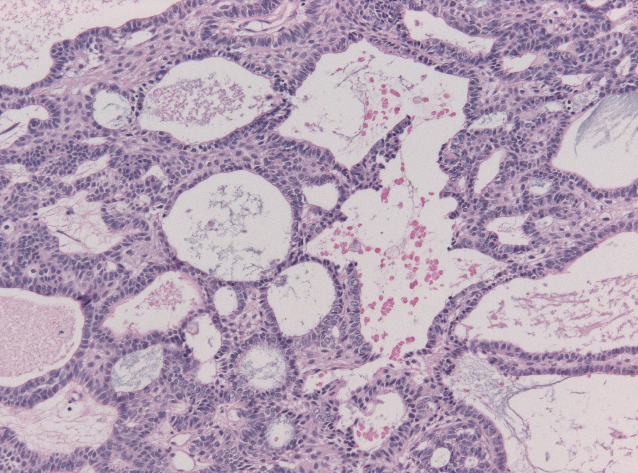 Microscopic tissue with curved epithelial nests and cords, dark peripheral nuclei in a palisaded arrangement, and paler internal tissue and spaces.