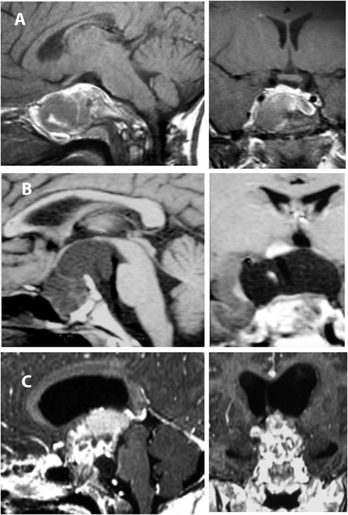 Three rows of paired sagittal and coronal enhanced T1 MRI. A shows a mass with a separable hypothalamus; B has a large cyst displacing it; C has poorly separable tumor and hypothalamus with enlarged ventricles.