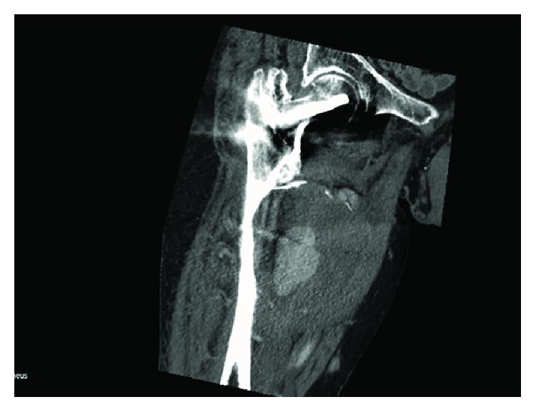 Published contrast CT showing proximal femoral fixation hardware, a large medial thigh collection, an internal contrast-dense region and adjacent femoral cortical scalloping.