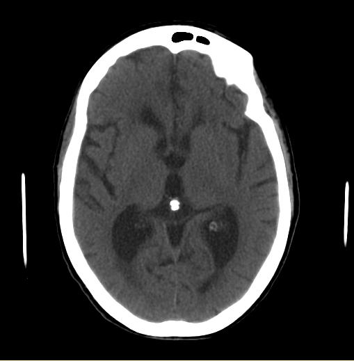 Unmodified axial head CT showing enlarged central lateral ventricular spaces surrounded by brain tissue.