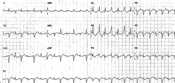 Published twelve-lead electrocardiogram showing ventricular tachycardia with alternating QRS directions, especially visible in lead III. Calibration text is not reliably readable in this reproduction.