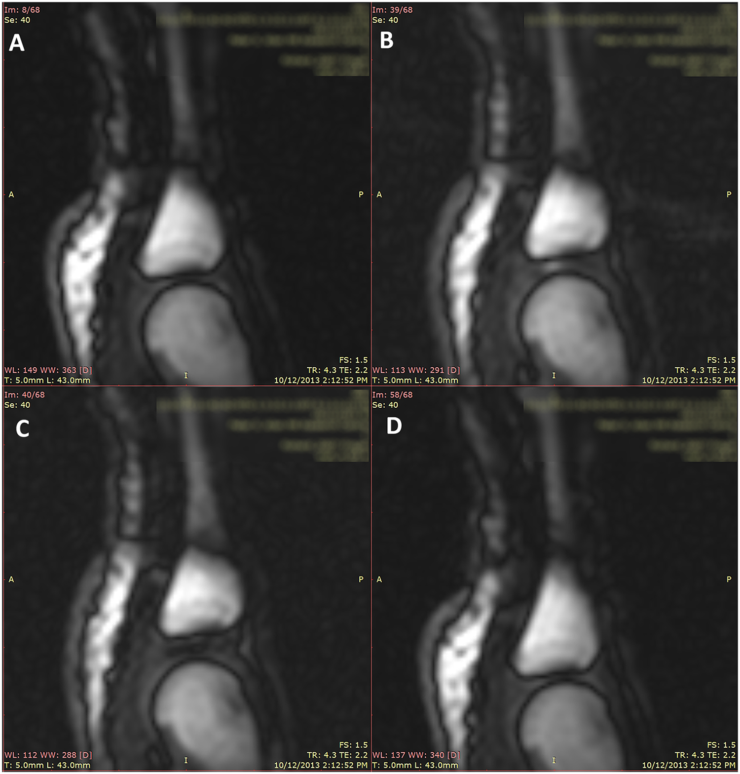 Four finger-joint MRI panels: A at rest, B before cracking, C with a cavity after cracking, and D after distraction is released.