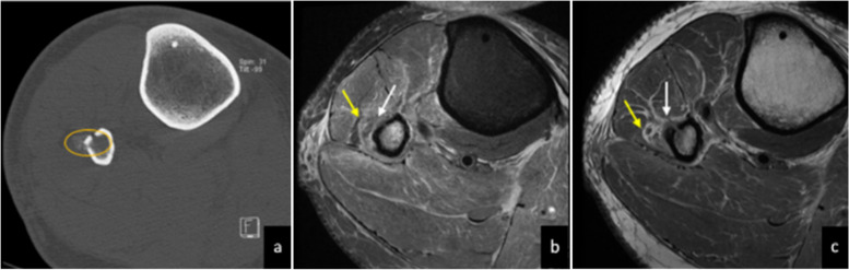 Three published panels: proximal fibular CT with circled fracture-related new bone, then two axial MR images with arrows identifying nearby fibular nerve branches.