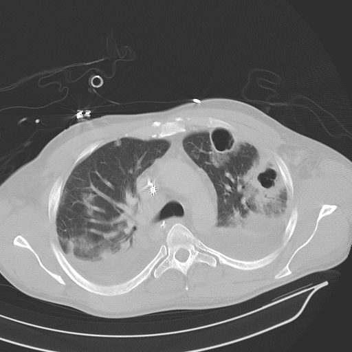 Axial chest CT with two gas-containing cavities in consolidated left lung, additional bilateral pulmonary opacities and posterior pleural fluid.
