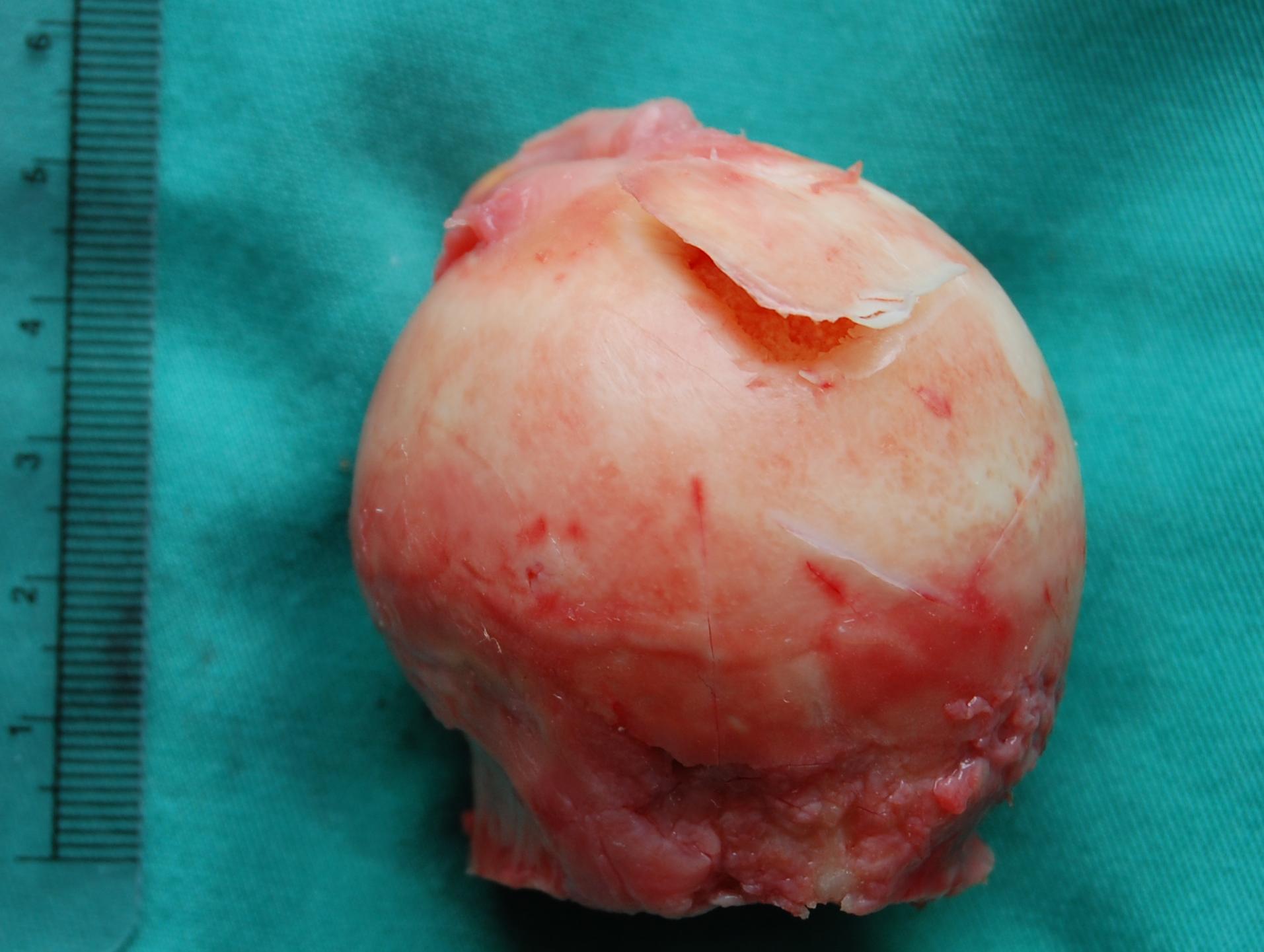Gross femoral head specimen with an upper cartilage flap and underlying osteonecrosis; a centimeter ruler is visible.