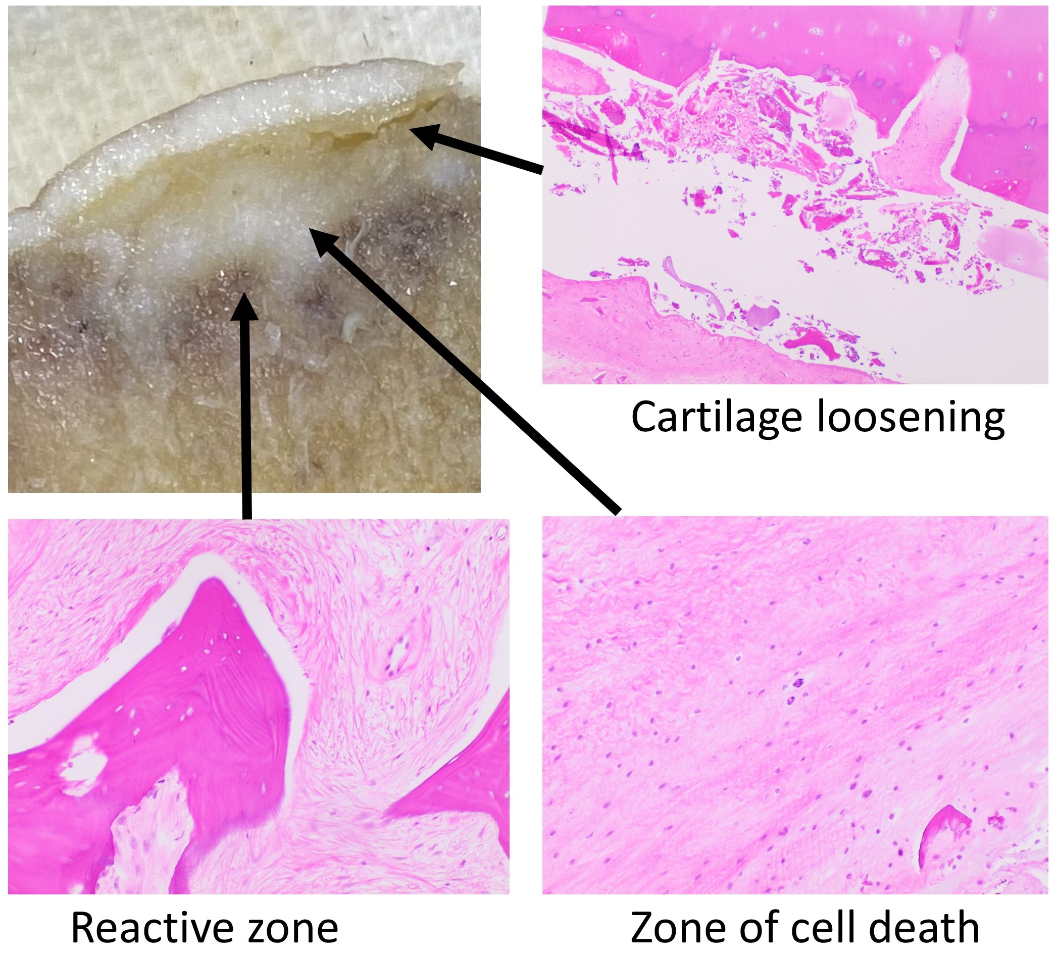 Original annotated montage of a femoral head cross-section and three histology views of osteonecrosis.