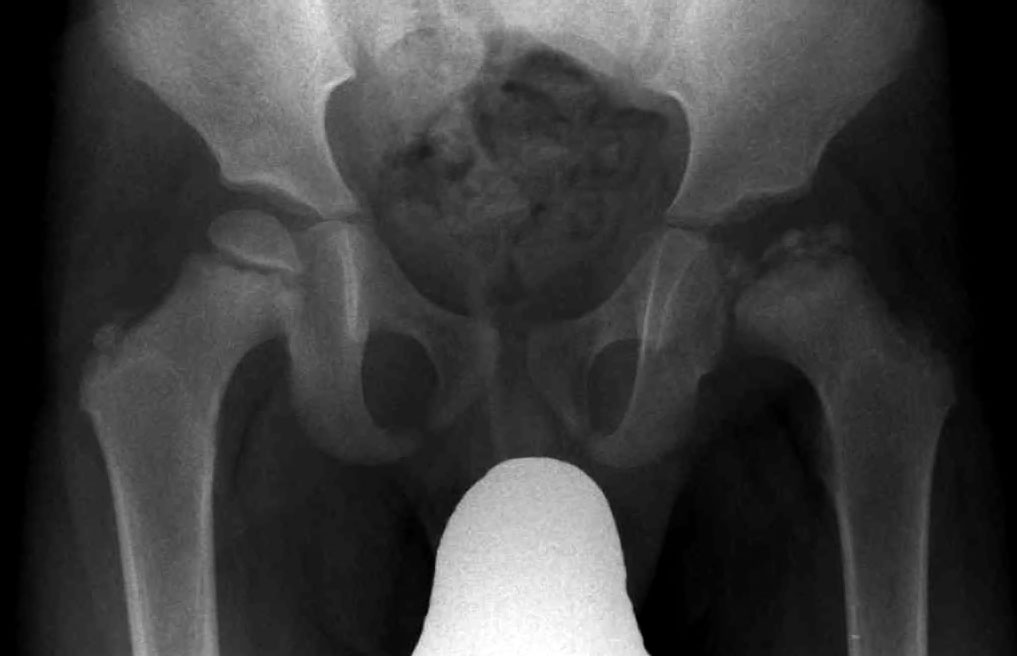 Pelvic radiograph showing a structurally abnormal left femoral epiphysis compared with the opposite side.