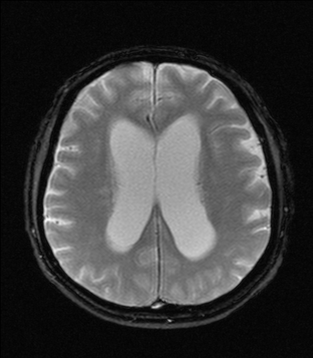 Axial MRI showing enlarged fluid-bright lateral ventricles in a source-described patient with NPH.