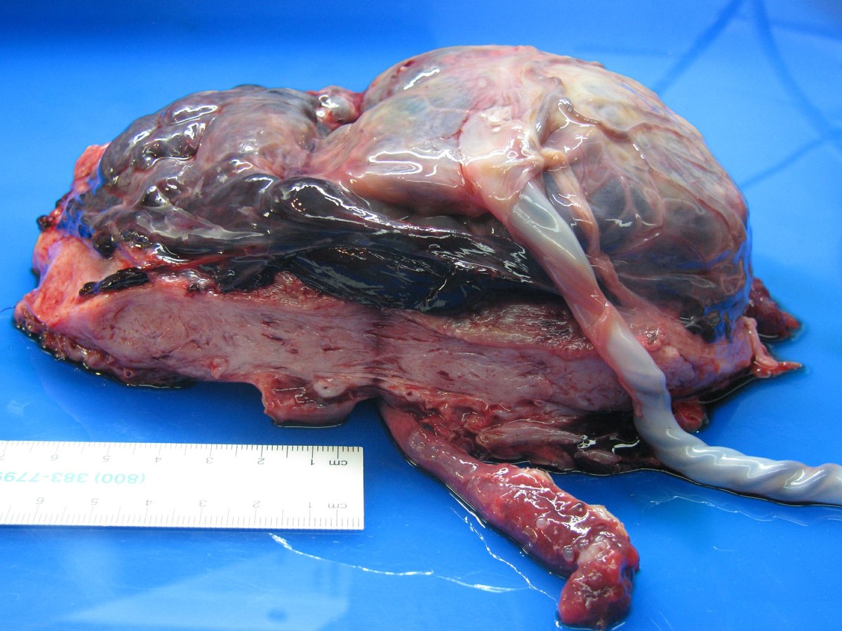 Gross pathology photograph of an opened uterus showing a dark retroplacental hematoma separating part of the placenta from the uterine wall.