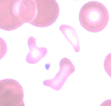 Wright-Giemsa blood smear with irregular red-cell fragments among intact round red cells