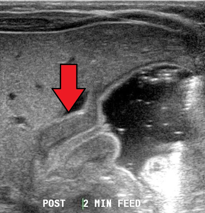 Clinical longitudinal ultrasound showing the elongated pyloric region adjacent to a fluid-filled stomach. The red arrow is part of the original image.