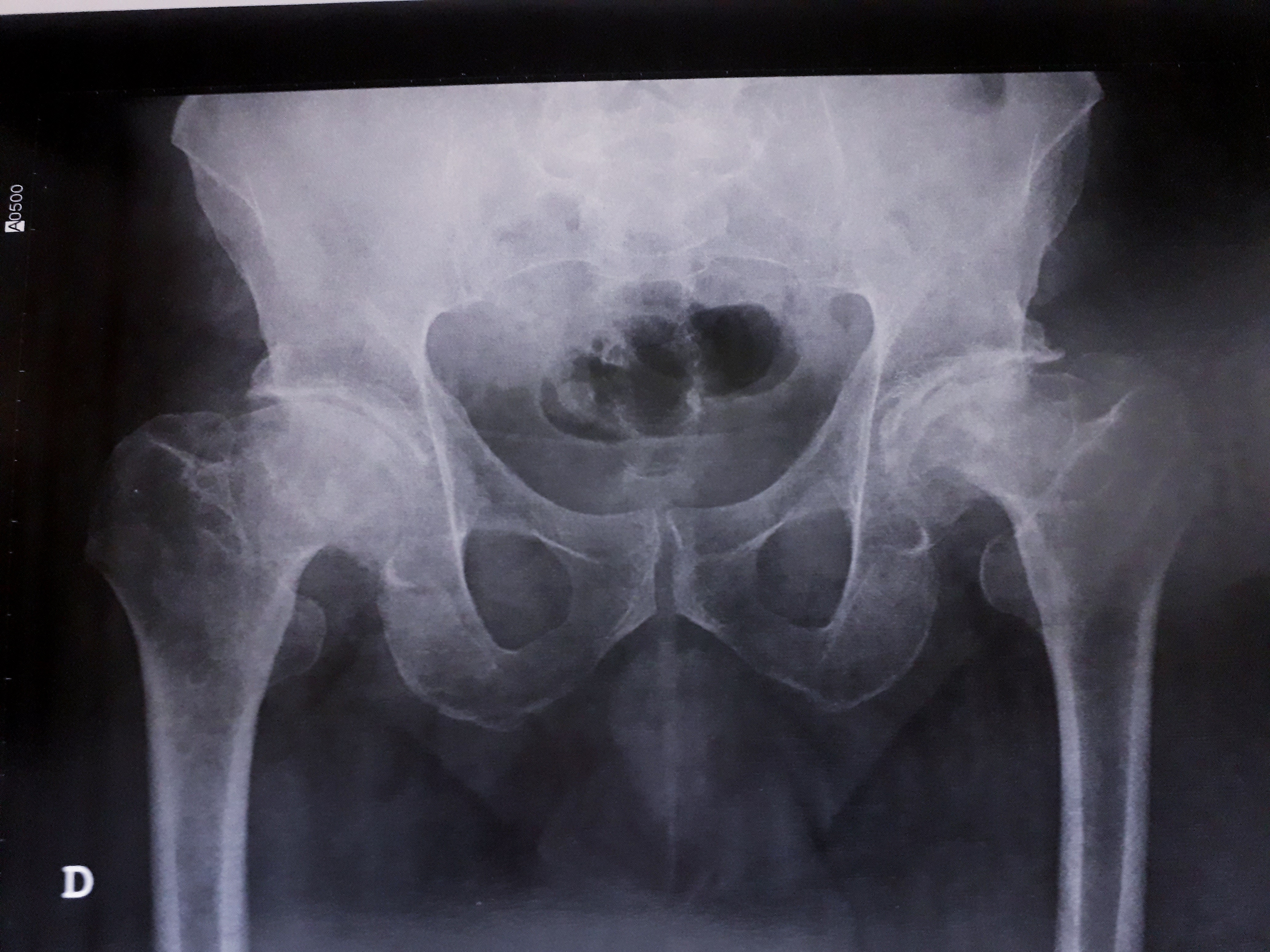 Pelvic radiograph from an adult with residual femoral head deformity attributed to Perthes disease in the image source. This is not an early pediatric diagnostic film.
