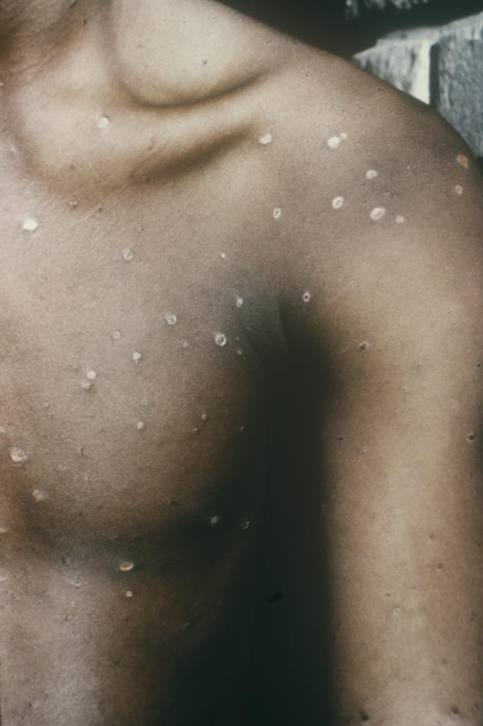 Unaltered CDC clinical photograph of the upper trunk and shoulder during healing varicella on day eight, with scattered pale healing areas and residual crusted spots.