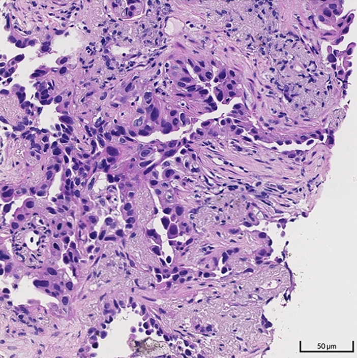 Hematoxylin and eosin micrograph of lung adenocarcinoma with acinar architecture.