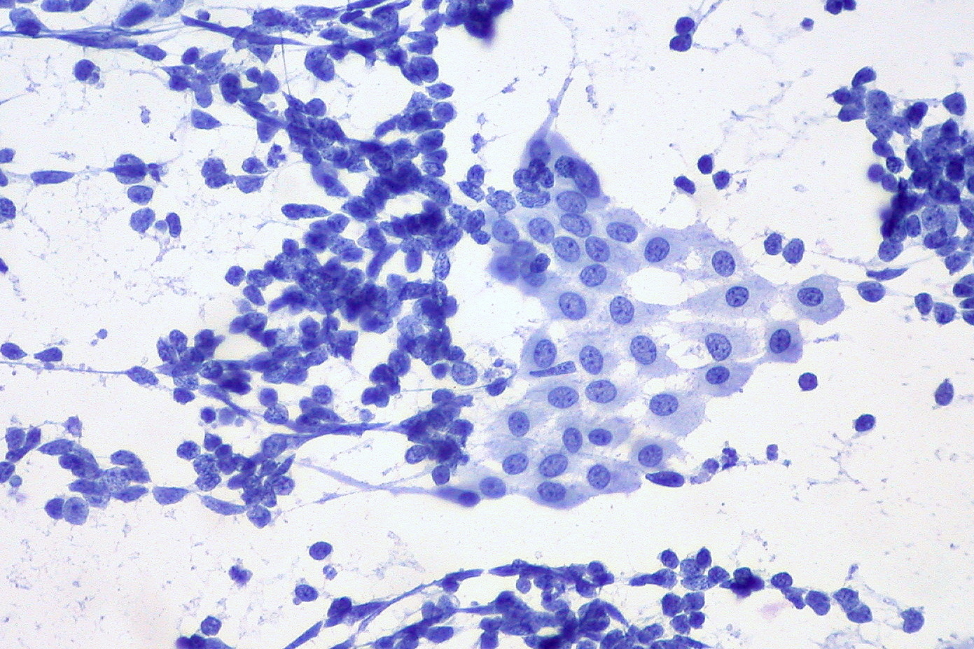 Fine-needle aspirate showing small cell lung carcinoma and benign mesothelial cells for comparison.