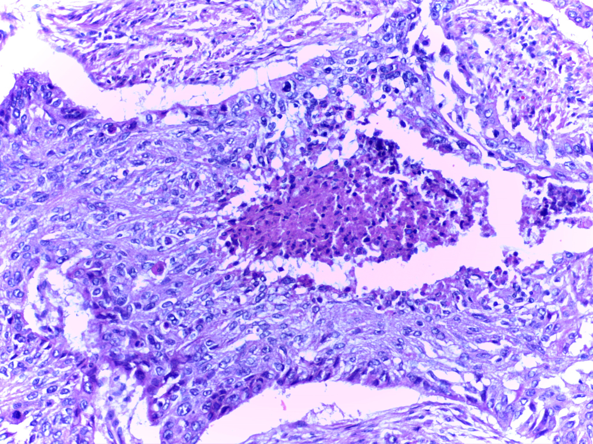 Hematoxylin and eosin photomicrograph showing irregular squamous epithelial tumor nests, abundant pale pink cytoplasm and curved keratinizing arrangements amid stroma.
