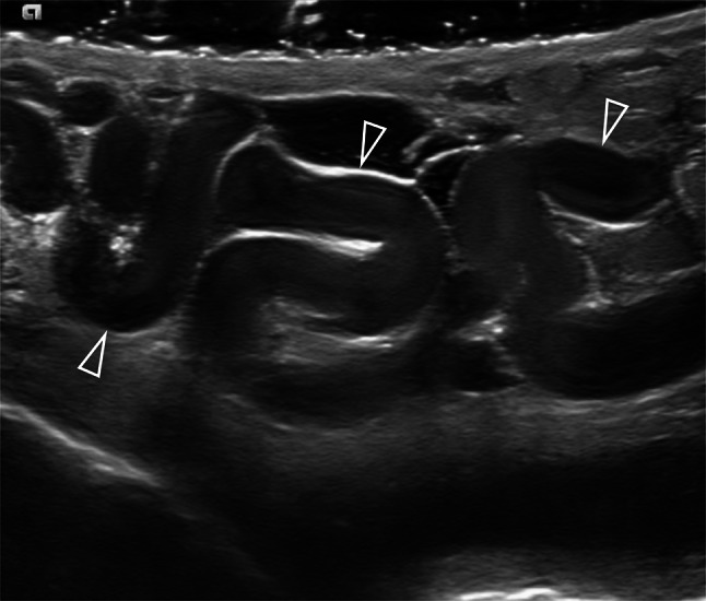 Multiple dark serpiginous dilated venous lumens identified by original white arrowheads.