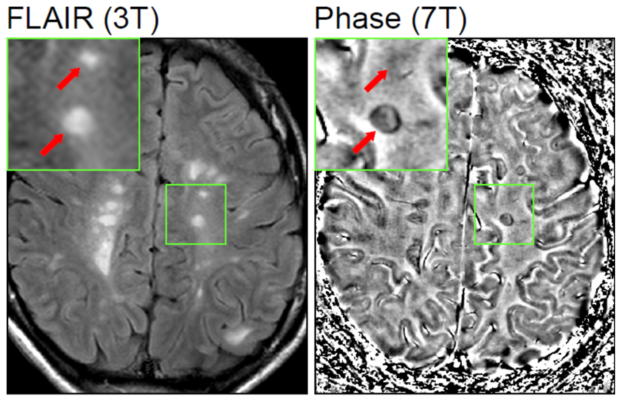 Original paired axial brain images: FLAIR on the left shows white matter lesions; GRE phase on the right shows different phase appearances in the boxed corresponding regions, with enlarged insets.