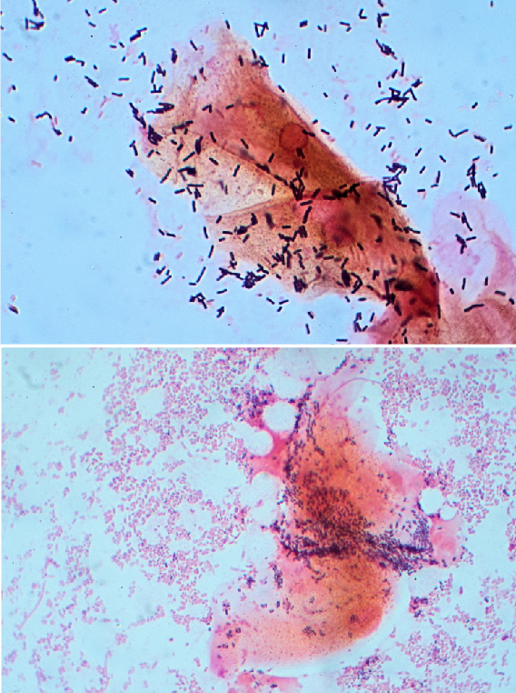Two clinical microscopy panels: larger rod-shaped bacteria in the upper panel and dense finer bacterial forms around epithelial material below.