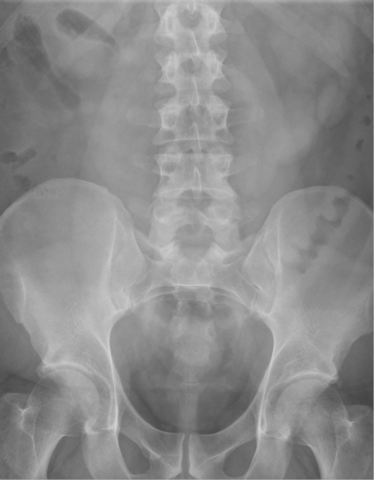 AP radiograph showing the lumbar spine and visible psoas soft-tissue borders on either side.