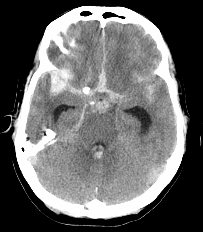 Axial head CT showing bright blood within basal subarachnoid spaces and fissures rather than a focal lens-shaped or crescentic extra-axial collection.