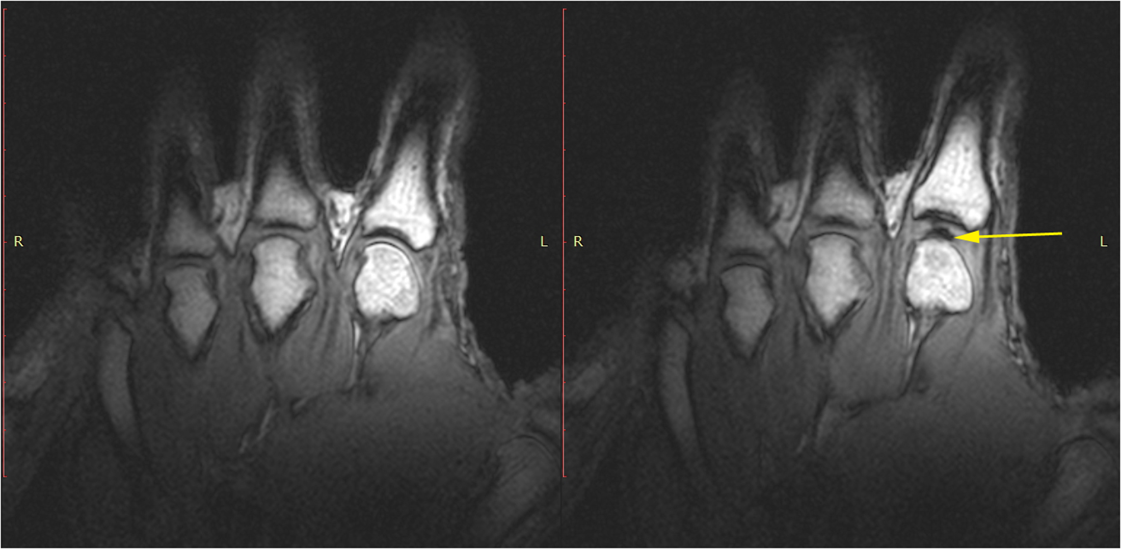 Published paired T1 MRI images of a human hand. The right panel shows a dark joint-space void marked by a yellow arrow after cracking and additional distraction.