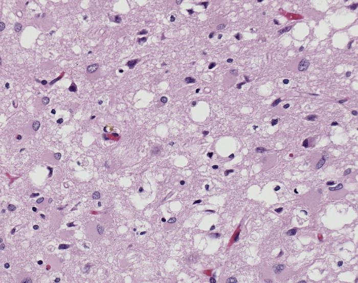Hematoxylin and eosin photomicrograph of cortex with numerous rounded pale vacuoles dispersed through pink tissue and scattered dark nuclei.