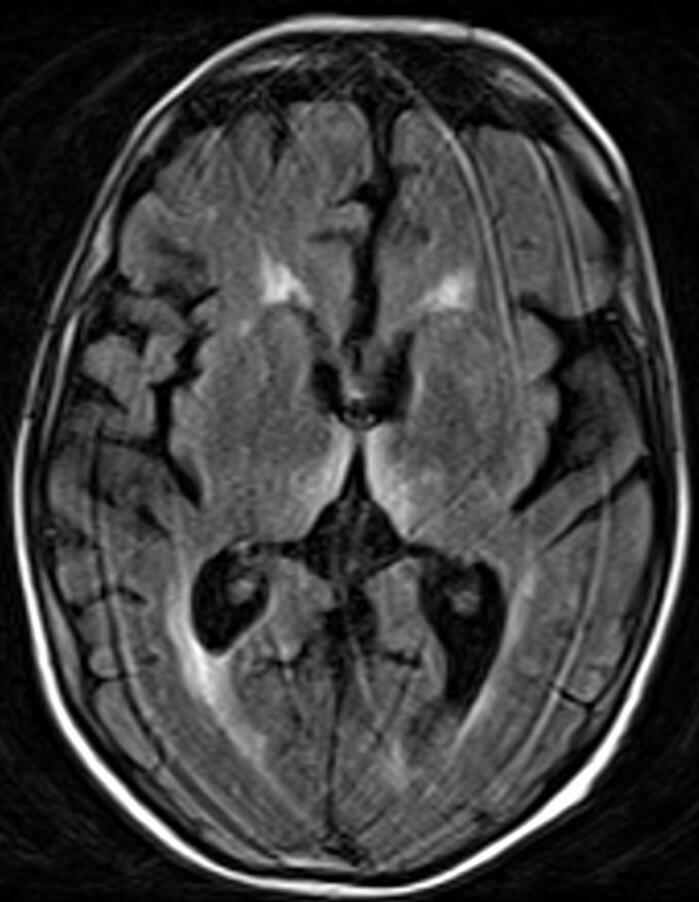 Axial brain FLAIR image with bilateral bright signal in the medial thalami bordering the third ventricle.