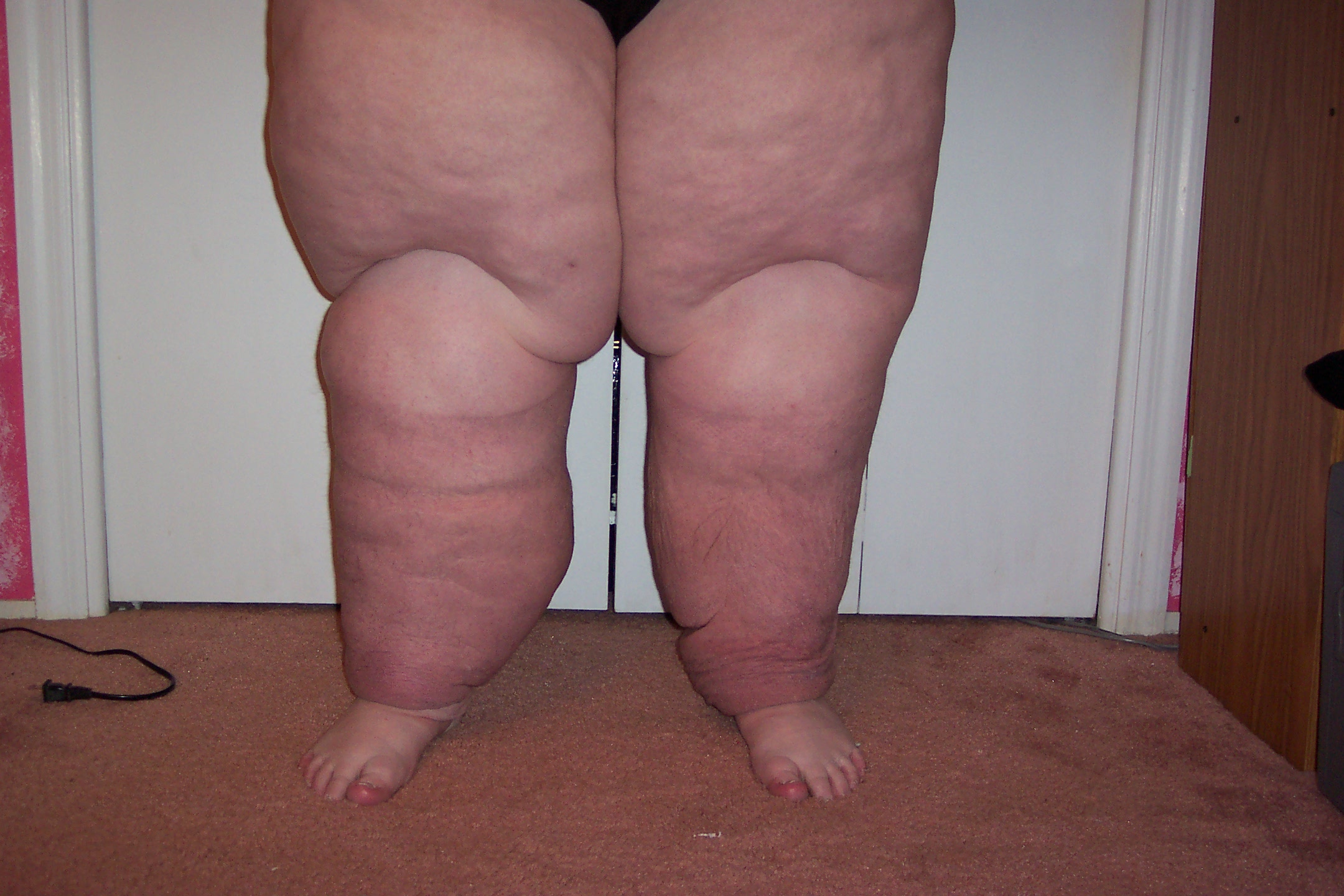 Marked bilateral lower-limb enlargement with deep folds and swelling extending toward the feet.