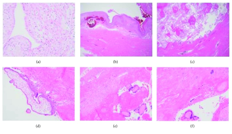 Six histology panels from Bartels and colleagues compare decidualized endometrium, direct villous contact with muscle and a nonadherent region with intervening decidua.