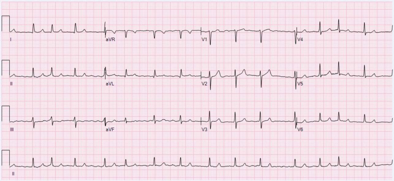 Twelve-lead ECG with a continuous lead II strip showing irregular R-R intervals, narrow QRS complexes, and no consistent preceding sinus P waves.