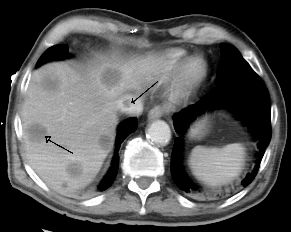 Axial contrast-enhanced CT with existing source arrows indicating a caval filling defect and a hepatic lesion. The source describes clot in the inferior vena cava and liver metastases in Budd-Chiari syndrome.