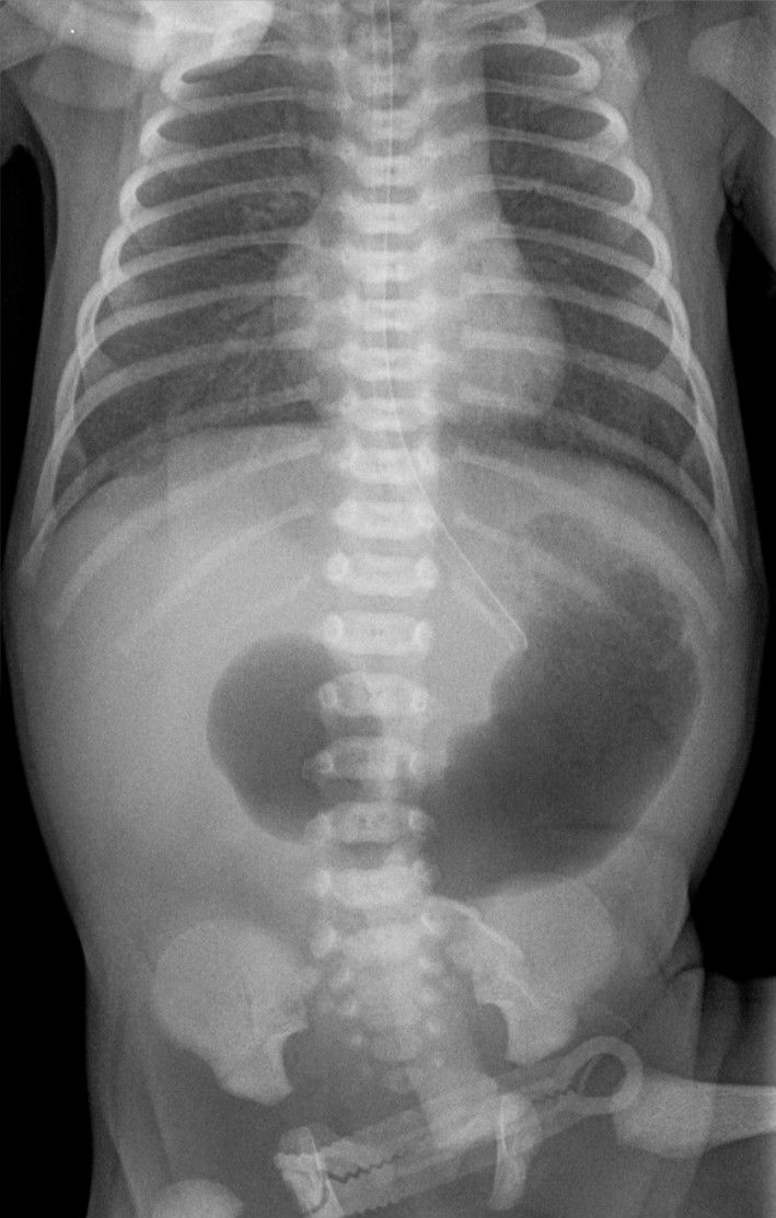 Frontal neonatal radiograph with a larger dark gas-filled stomach on the viewer's right and a smaller proximal duodenal gas bubble on the viewer's left. Distal bowel gas is not apparent.