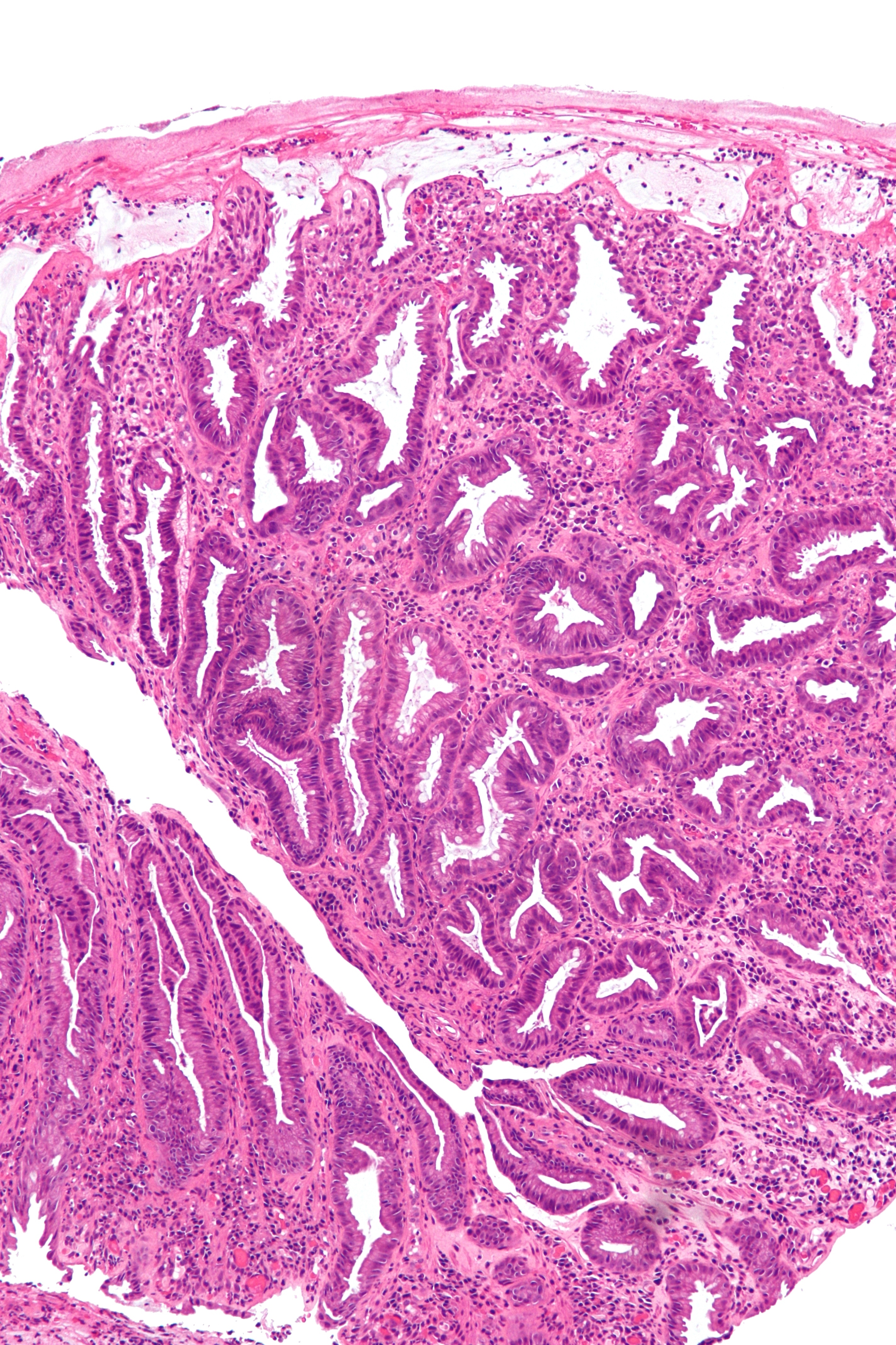 Unmodified H and E section of ischemic colonic mucosa with irregular surface and crypt injury and areas of hemorrhagic change.
