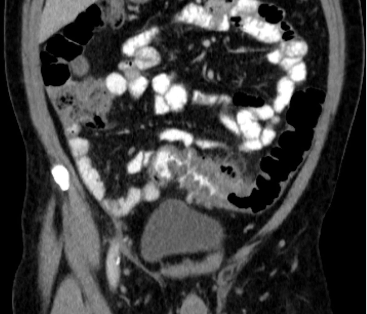 Coronal CT with thickened sigmoid bowel above the bladder, inflammatory change and adjacent gas.