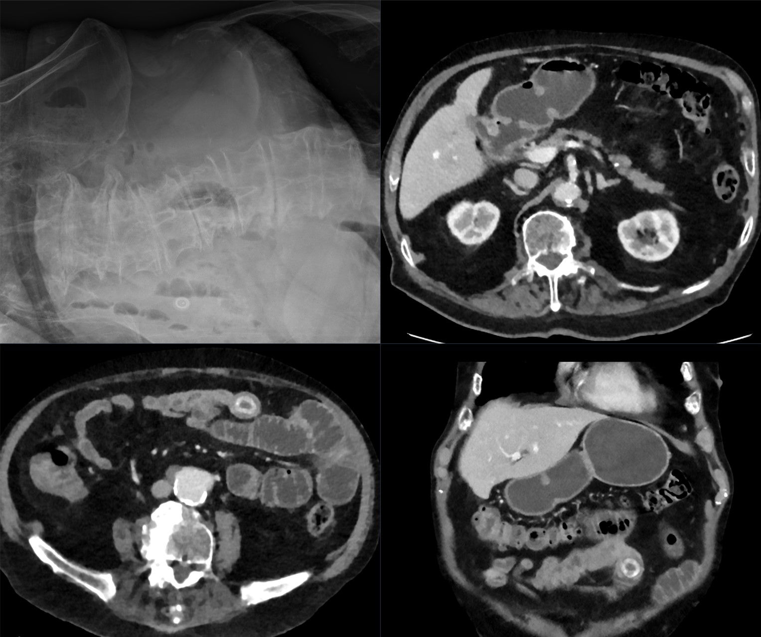 Four-panel clinical montage: a radiograph at upper left and CT images showing a ring-calcified stone within small bowel, with distended bowel before it and decompressed bowel beyond it.