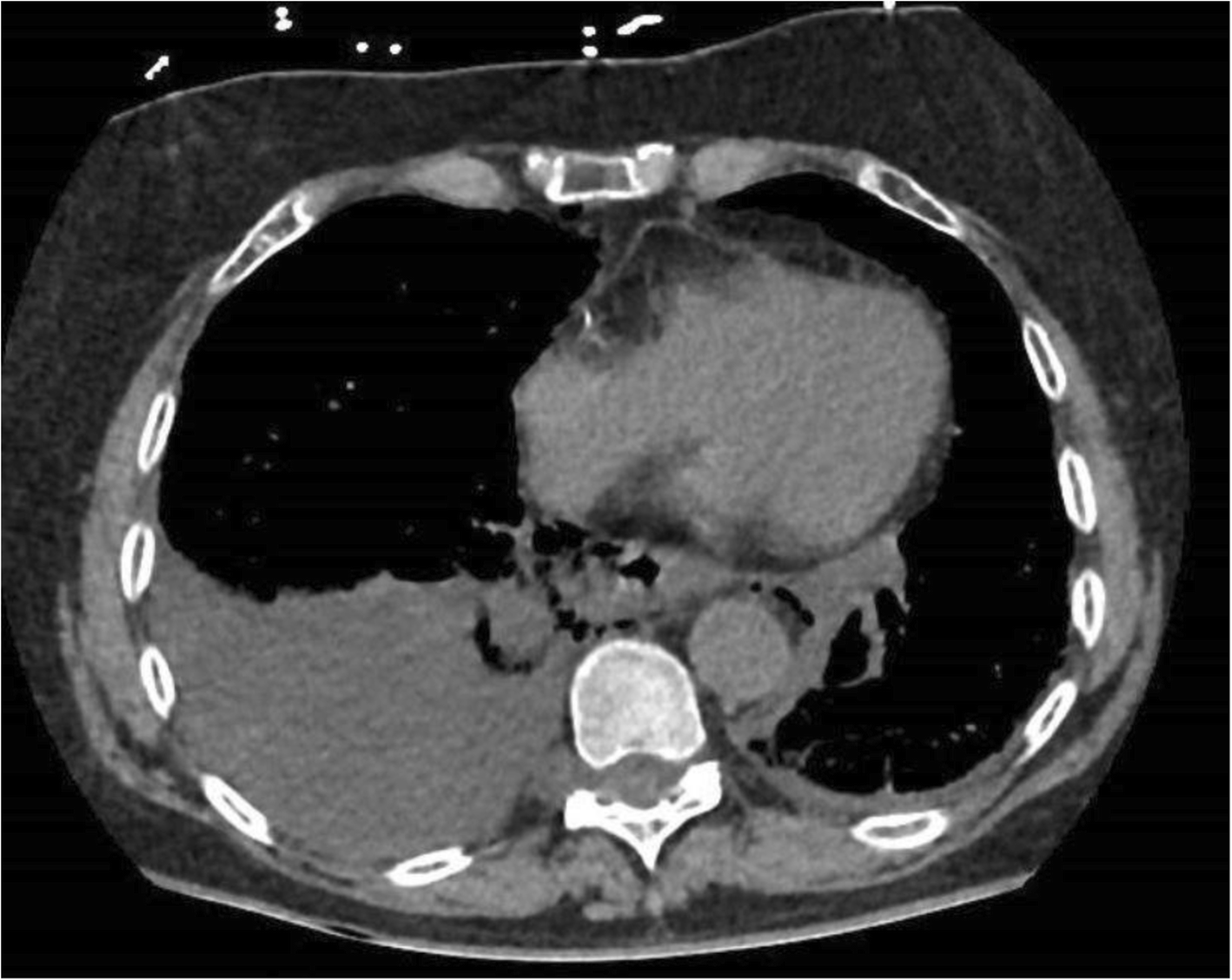 Axial CT from a reported Boerhaave case demonstrates mediastinal air, esophageal wall disruption and right pleural fluid. Patient right is on the left of the displayed image.