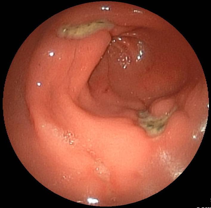 Endoscopic view of gastric antral mucosa with pale-based ulcer craters and surrounding reddish folds.