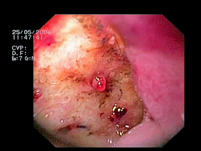 Endoscopic view of an ulcer base with a reddish protruding vessel and darker adherent material.