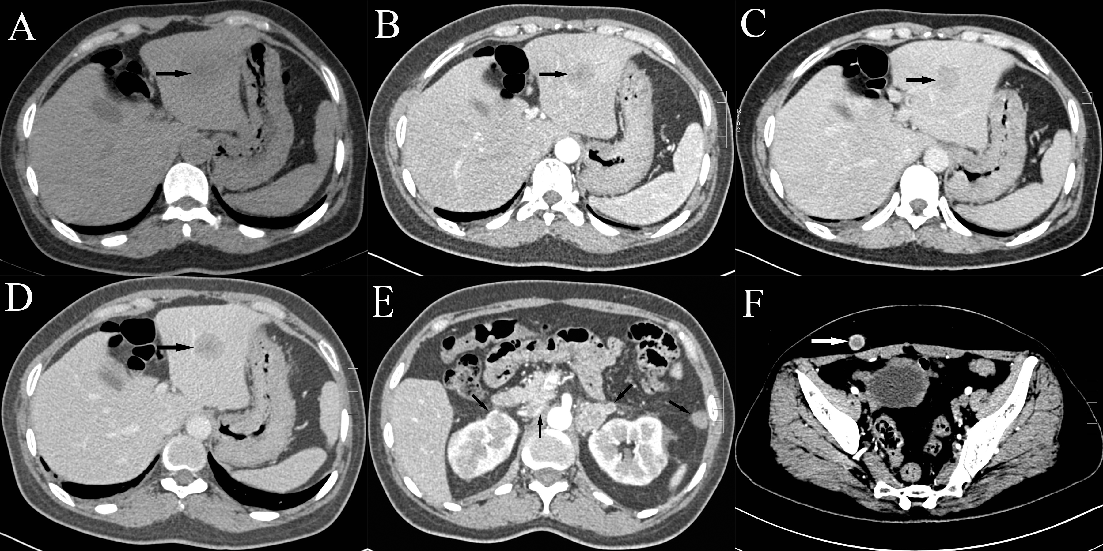 Six original abdominal CT panels. Panels A to D show left-lobe liver lesions before and during contrast enhancement. Panels E and F show additional abdominal and subcutaneous lesions indicated by original arrows.