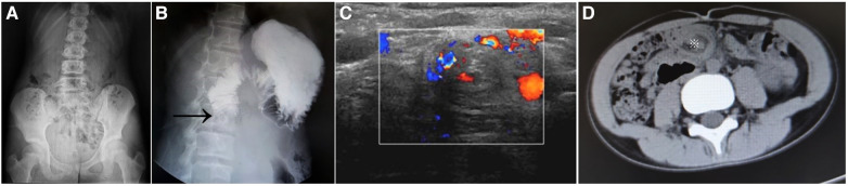 Four published patient images: A, abdominal radiograph with scant bowel gas; B, upper GI contrast image with an arrow at duodenal obstruction; C, color Doppler ultrasound showing a mesenteric whirlpool; D, axial CT showing a mesenteric whirlpool marked by an asterisk. These are a modality comparison, not a sequential study of one patient.