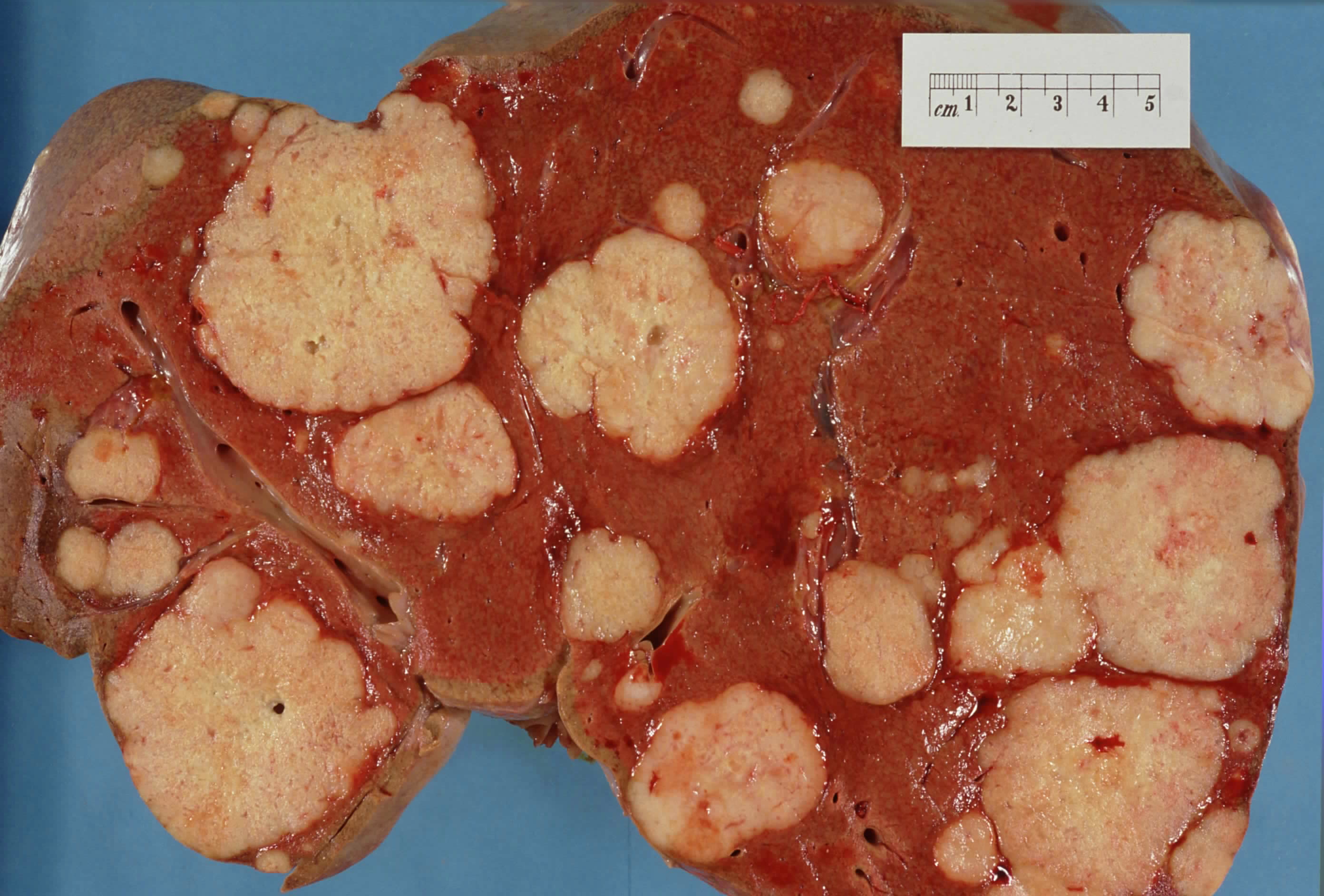 Gross liver cut surface contains numerous pale nodules of different sizes separated by reddish-brown liver tissue; a centimeter ruler is visible.
