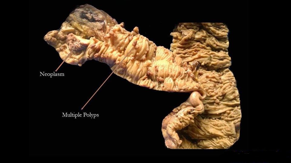 Opened bowel contains many raised polyps and a larger irregular lesion; original labels identify multiple polyps and a neoplasm.