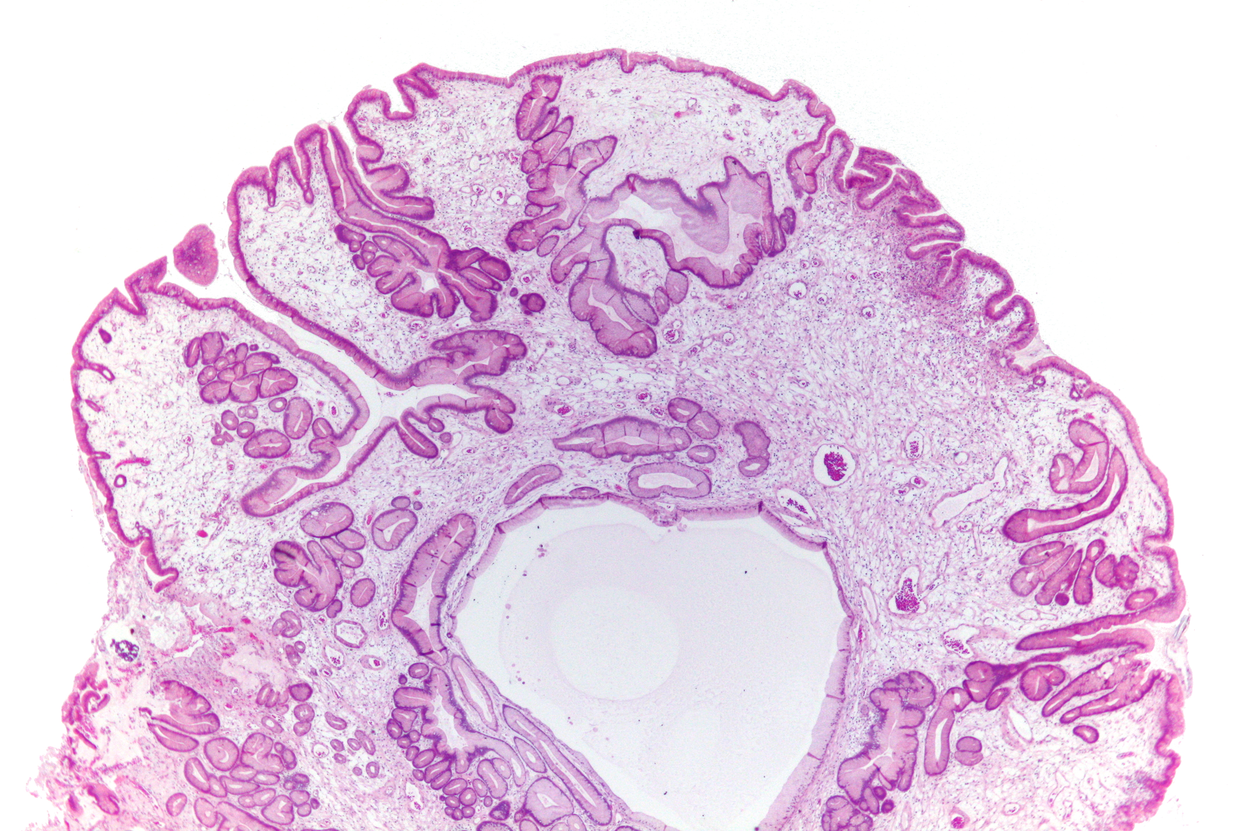 Very-low-magnification H&E micrograph shows multiple dilated glands, including a large central cystic space, within a gastric juvenile polyp.