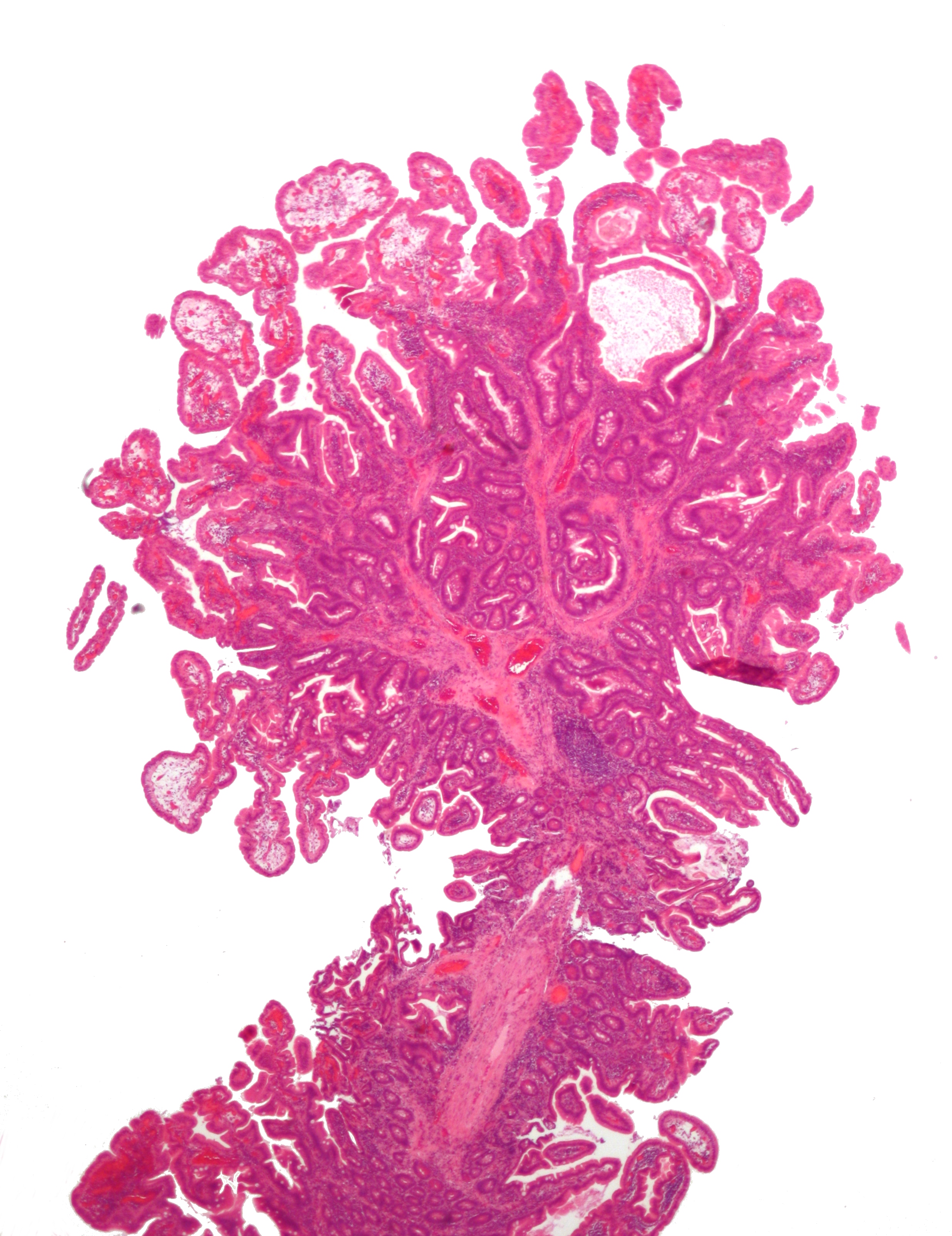 Low-magnification H&E micrograph of a branching intestinal polyp with supporting smooth-muscle bundles.